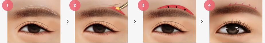 Sub Brow Lift Surgery Method