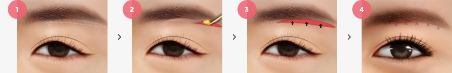 Sub Brow Lift Surgery Method