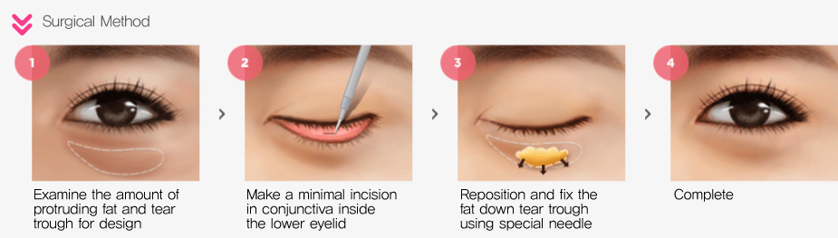 One Day Under Eye Fat Reposition - Surgery Method