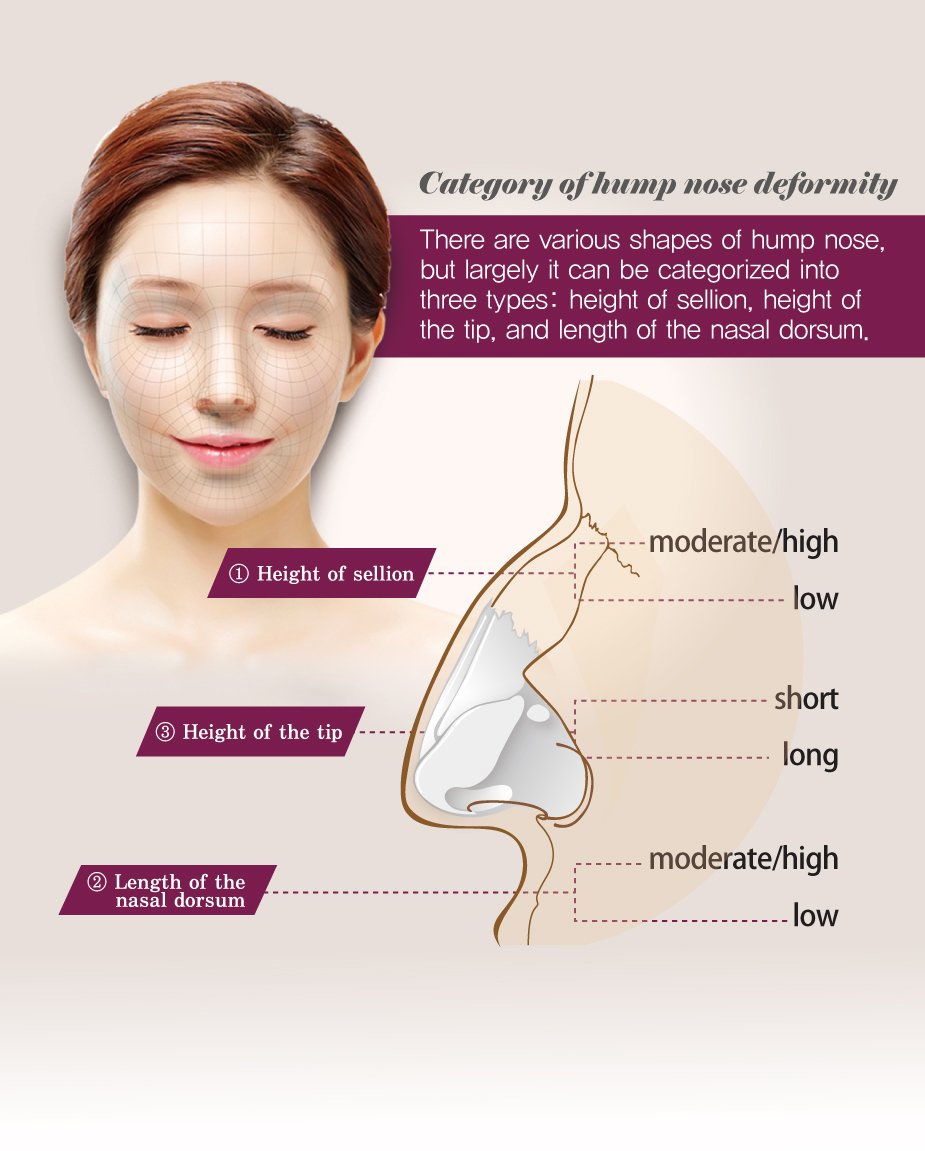 Category of hump nose deformity - Height of sellion, Height of the tip and Length of the nasal dorsum.