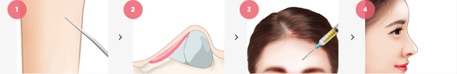 Nose Surgery Surgery Method