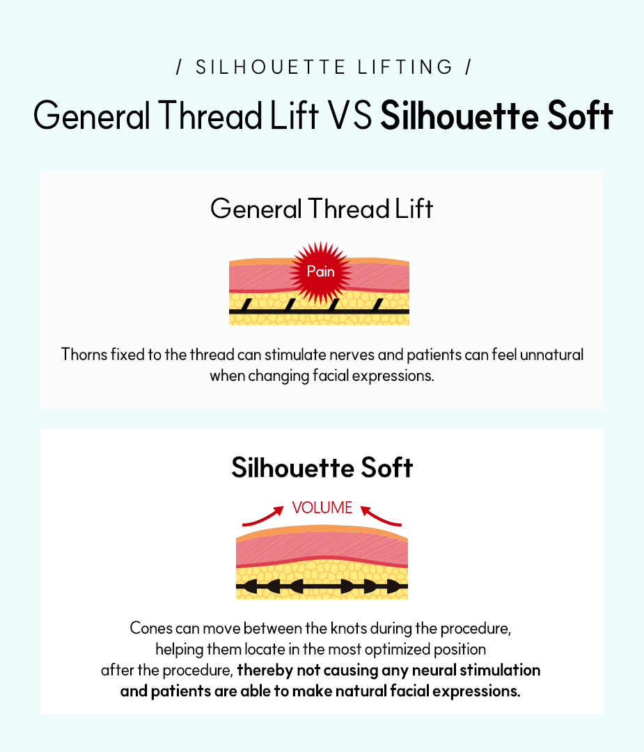 일반 실리프팅 - 짧은 실 여러 개를 직선으로 넣어 한쪽방향으로만 들어올리고 당깁니다. 실에 고정된 가시는 표정 변화 시 신경 자극이나 부자연스러움을 느낄 수 있습니다. 실루엣 리프팅 - 시술 시 매듭과 매듭 사이로 Cone이 이동할 수 있어 시술 후 가장 최적화된 피부위치에 자리 잡아 표정 변화 시 신경 자극이 없고, 자연스러운 얼굴표정을 나타냅니다.