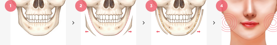 Square Jaw Surgery Surgery Method