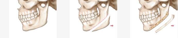 Square Jaw Surgery Surgery Method