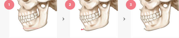 Chin Surgery Surgery Method