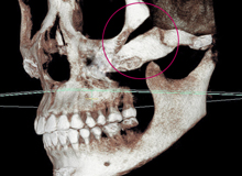 Widen osteotomy site