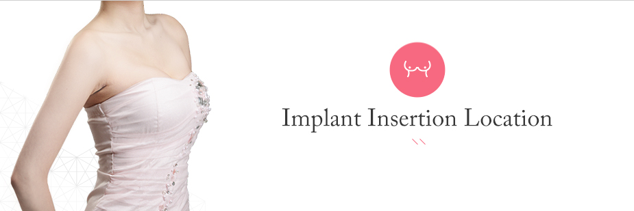 Implant Insertion Location